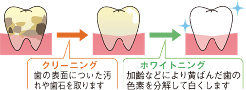 ホワイトニングとクリーニングの違い